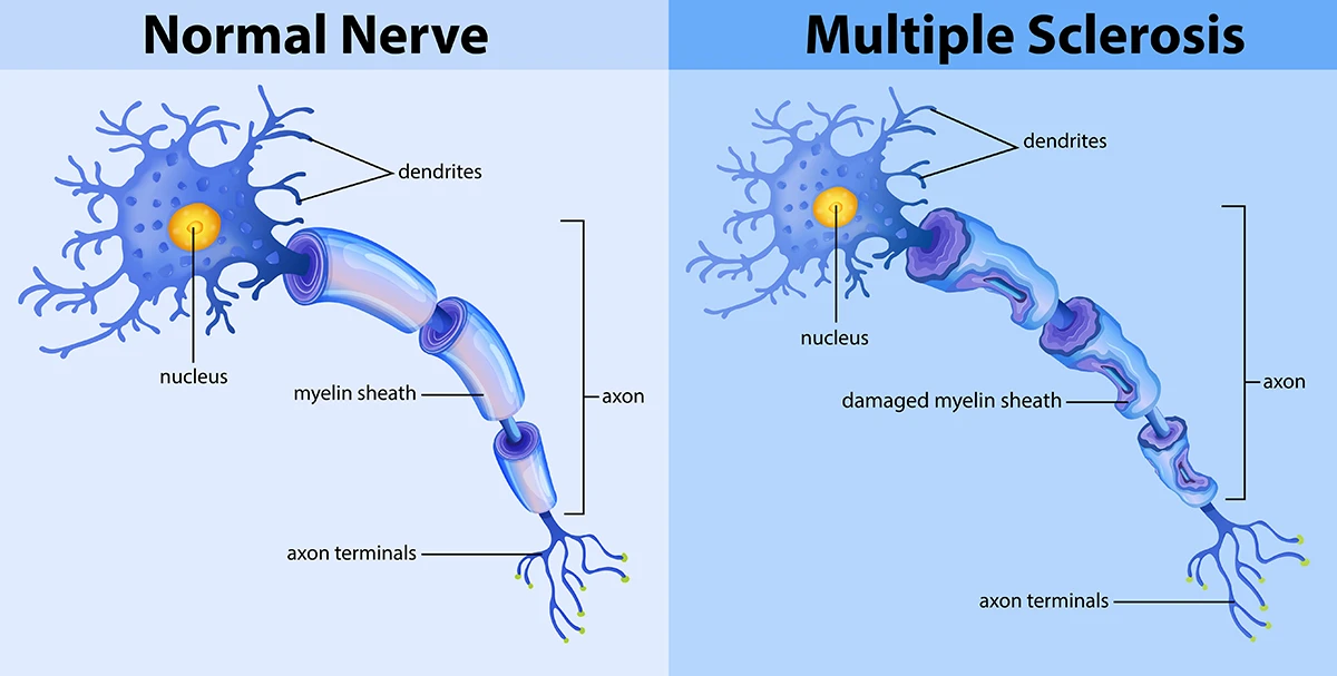 difference between fibromyalgia vs multiple sclerosis symptoms