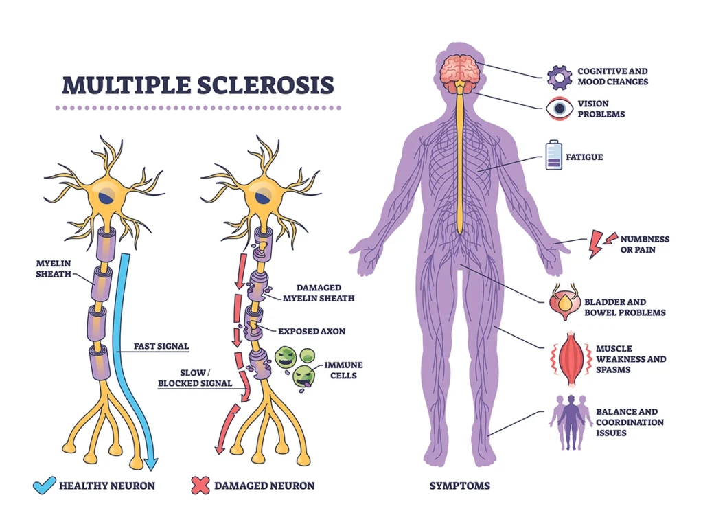multiple sclerosis and the body